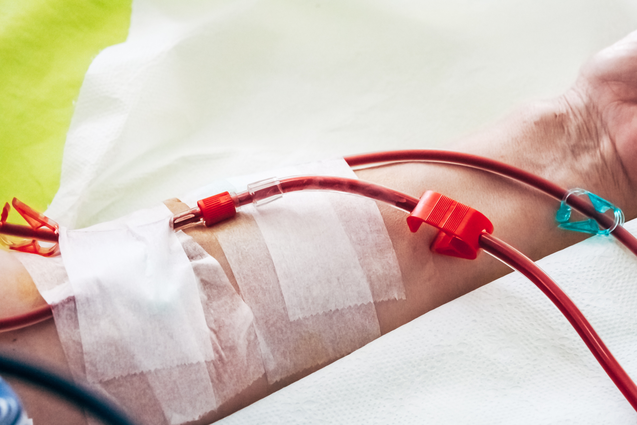 Patient*innenarm während einer Dialyse Patient*innenarm während einer Dialyse